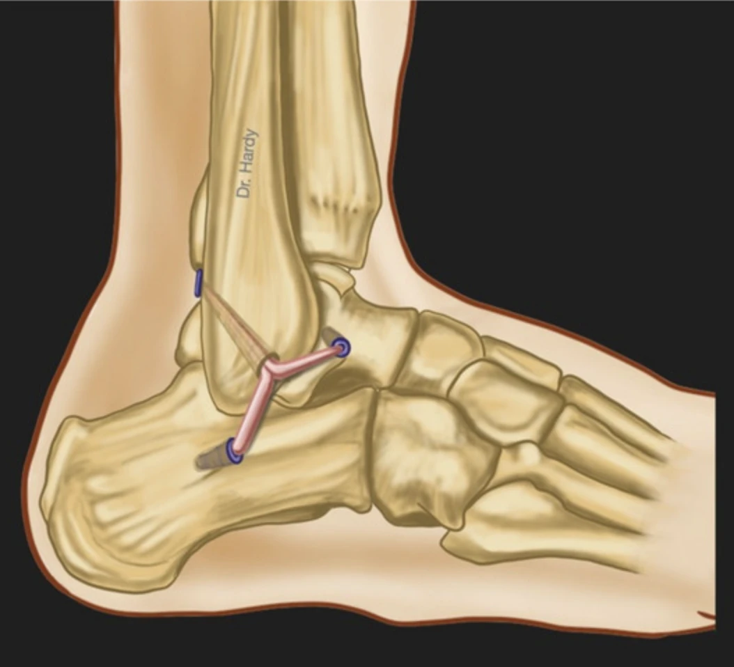 ALR-RSI (Ankle Ligament Reconstruction – Return to Sport after Injury)