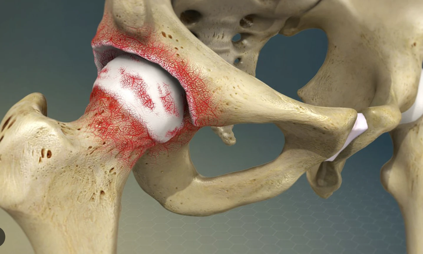 Hip Disability and Osteoarthritis Outcome Score (HOOS)