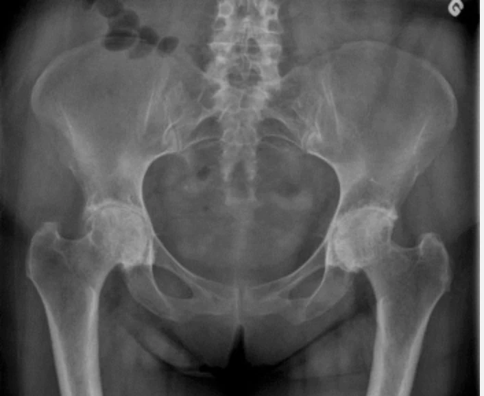 WOMAC Osteoarthritis Index (Western Ontario and McMaster Universities Osteoarthritis Index)