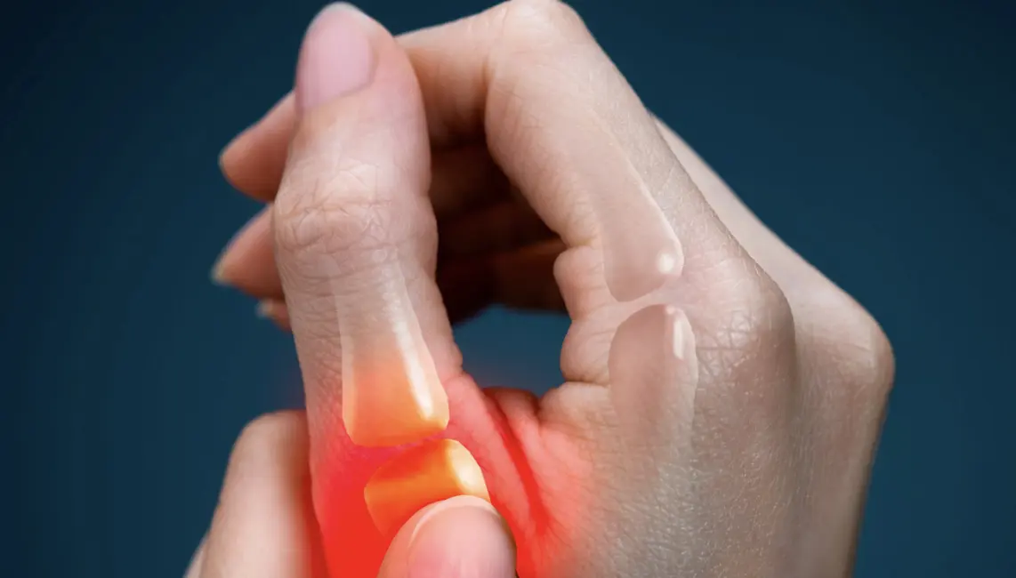 Arthrose de la base du pouce : caractéristiques cliniques, radiologiques et épidémiologiques 