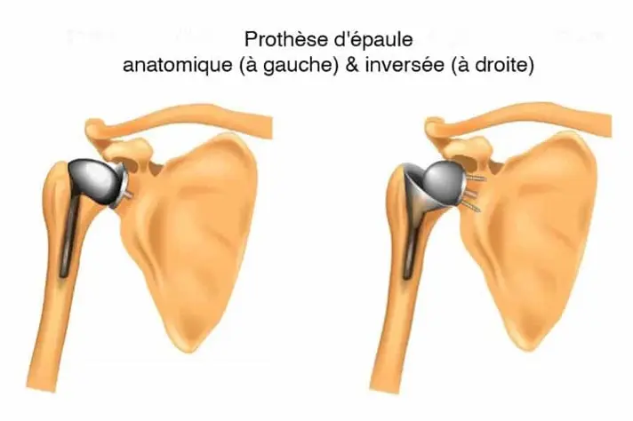 Image Prothèse inversée d'épaule : protocole de rééducation et 5 exercices avec RehabCloud